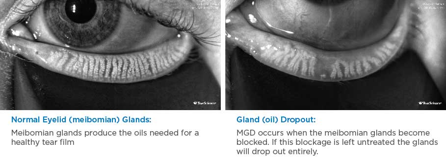 Normal vs. MGD gland comparison