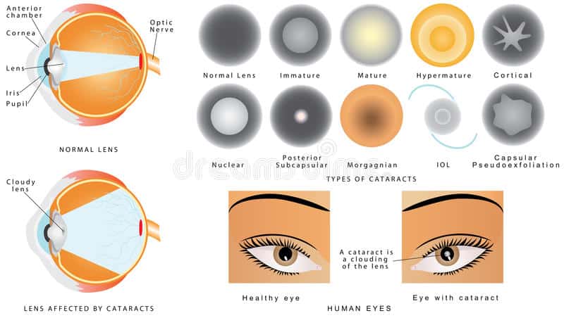 Types of Cataracts